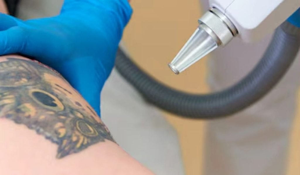 chemical tools for tattoo removal